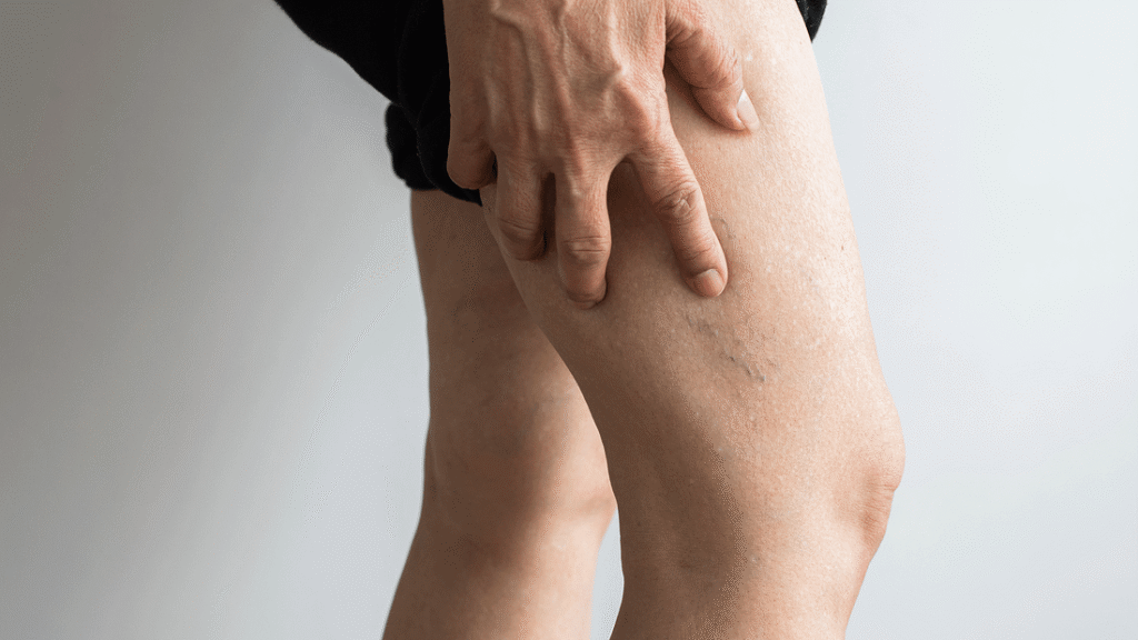 Thrombose-Selbsttest: Welche Anzeichen sind ernst zu nehmen? Thrombose-Selbsttest